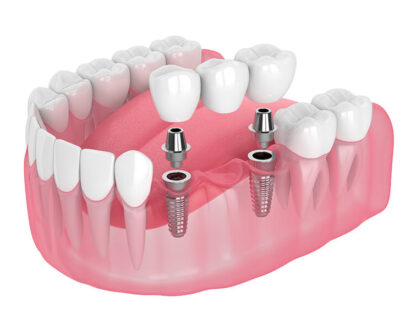Choosing A Dental Bridge Explained In 3 Steps